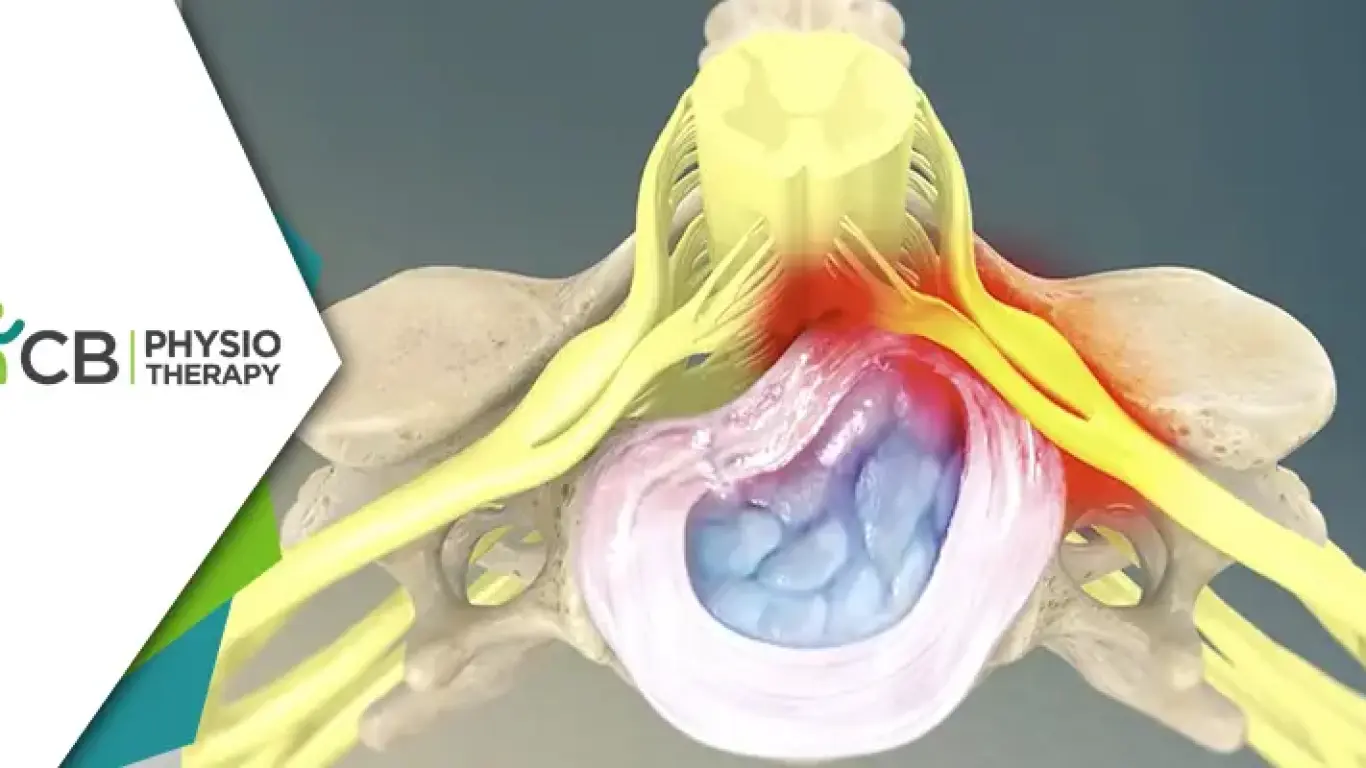 Cervical Myelopathy | How Physiotherapy Helps In Regaining Function And Control?