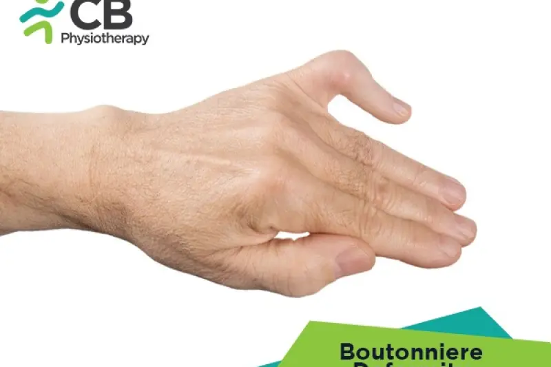 Boutonniere Deformity
