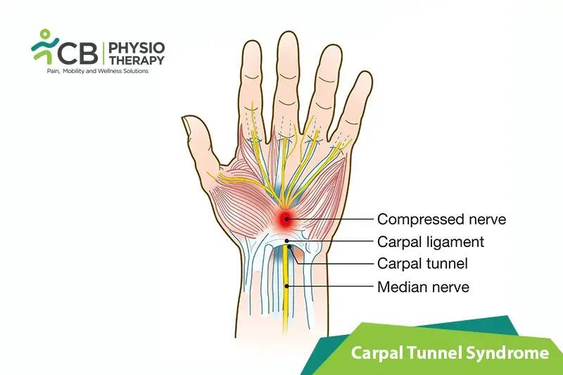 Carpal Tunnel Syndrome (cts)