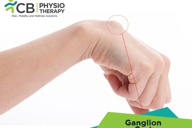 Ganglion Cyst