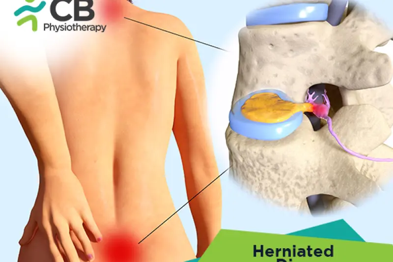 Herniated Disk Or Slipped Disc