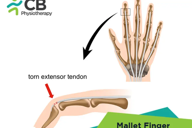 Mallet Finger