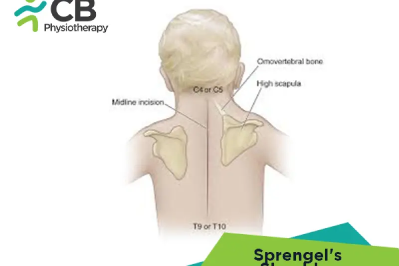 Sprengel's Shoulder
