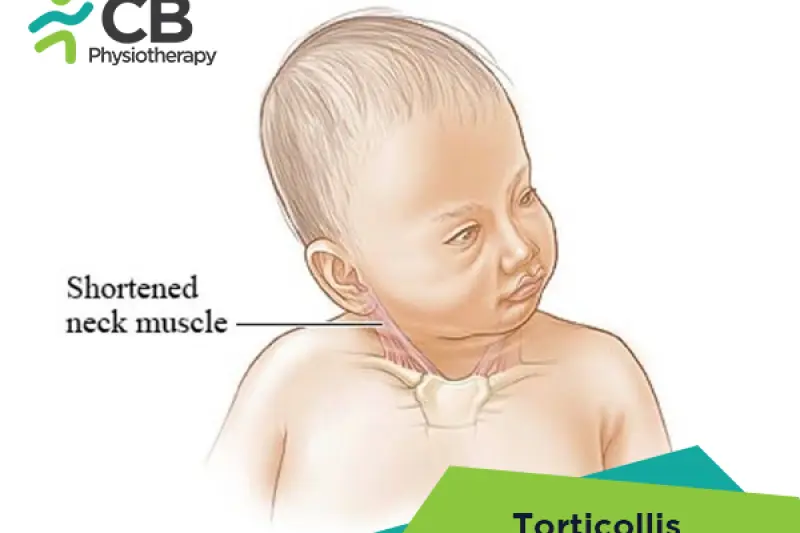 Torticollis
